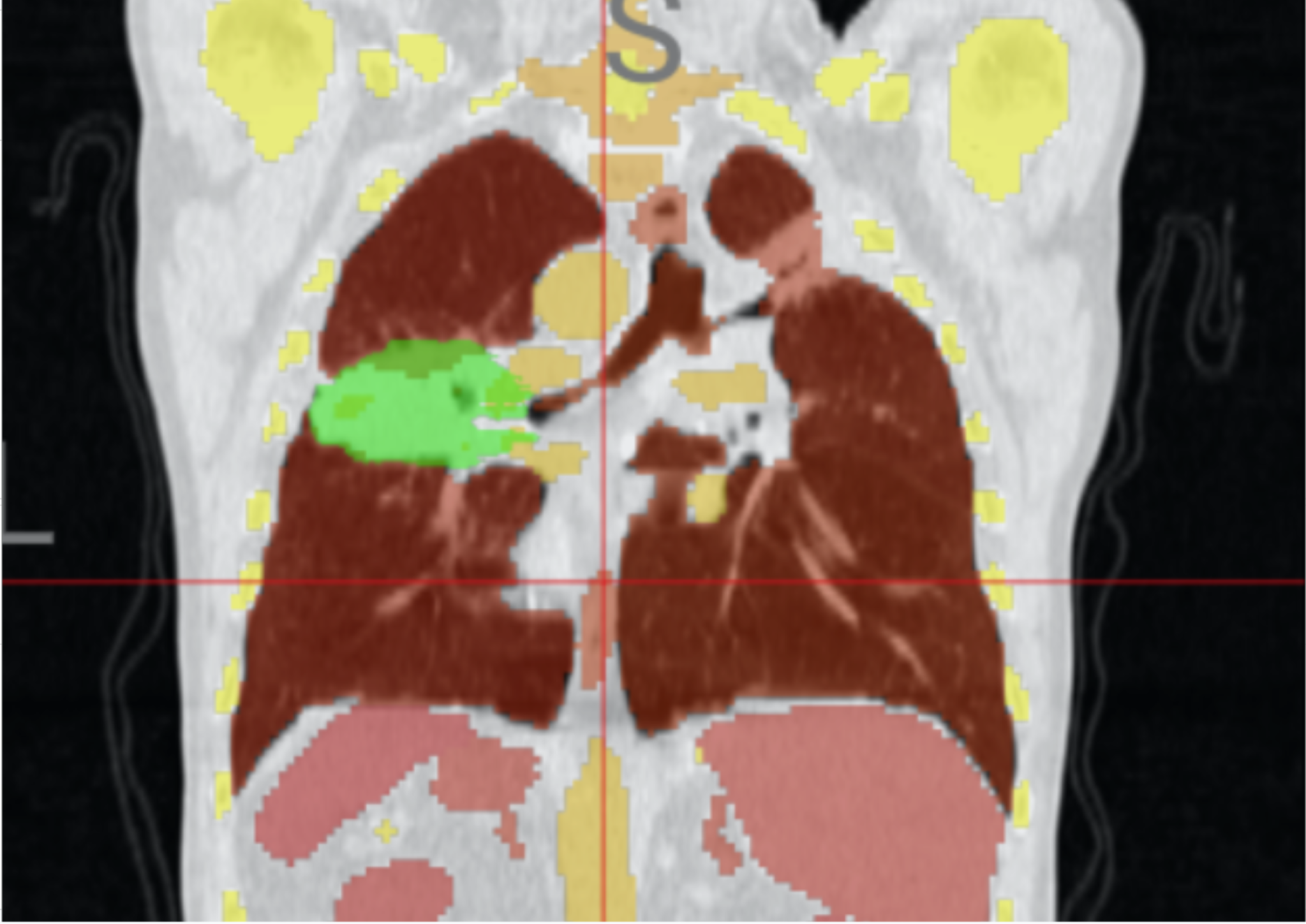 CT image with colored segmentation overlay.
