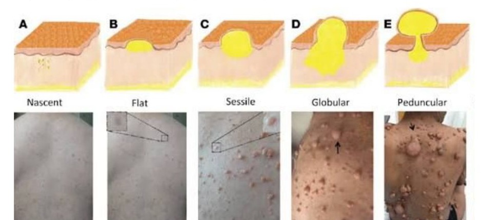 cNF morphology classes from nascent through pedunculated