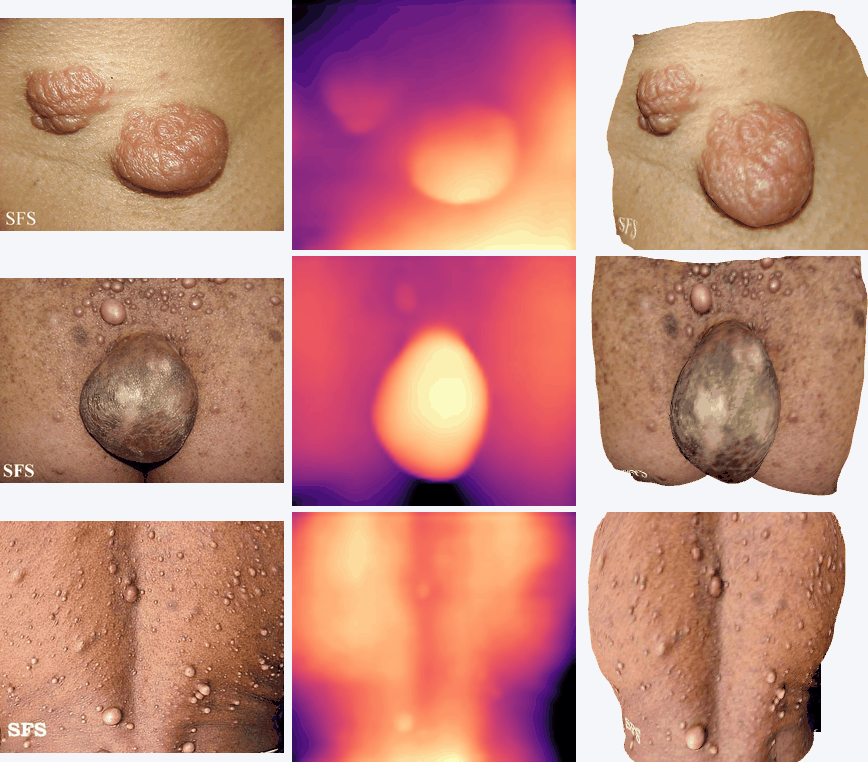 Depth Pro reconstructing rotating 3D skin surfaces from single Fitzpatrick images